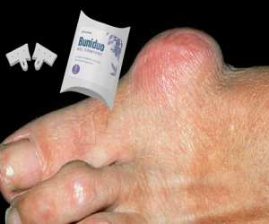 Buniduo Gel Comfort silicone toe separator - mellékhatásai?